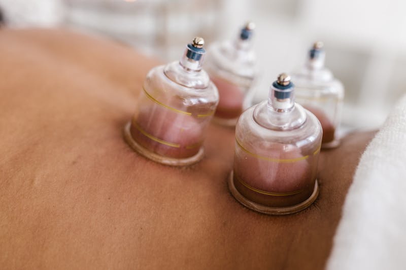 ครอบแก้ว (Cupping) บำบัดกล้ามเนื้อ คลายปวดตึง